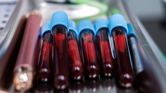 العد الدموي الشامل.. اختبار الدم الأكثر شيوعا الذي يخبرك الكثير عن صحتك