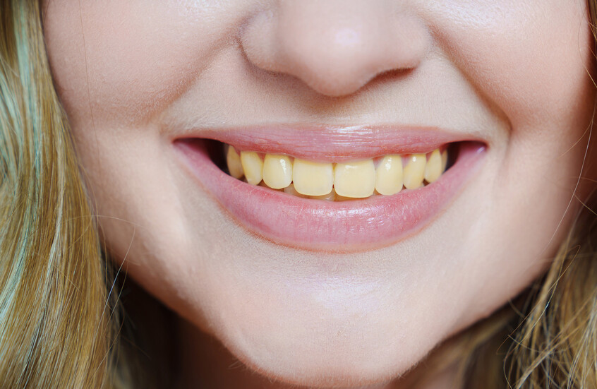 3 ممارسات شائعة تؤدي إلى اصفرار أسناننا