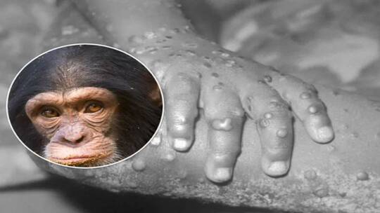 علماء: فيروس جدري القرود بدأ بالانتشار بين البشر في عام 2016