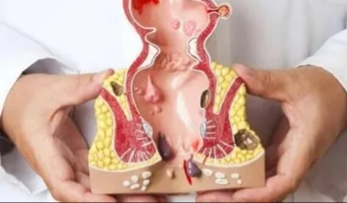 علاج البواسير بـ 16 طريقة منزلية سريعة وذات مفعول