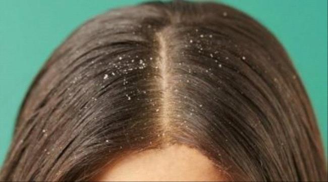 5 مكونات طبيعية تساعد فى علاج قشرة الرأس 